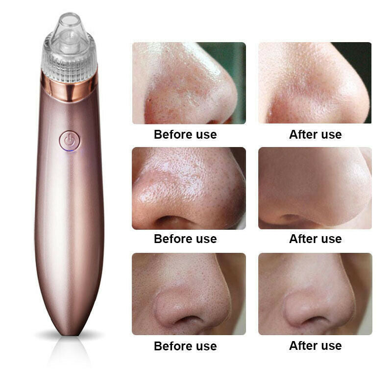 Electric Blackhead Vacuum Pore Cleaner 2.0